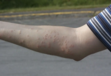 Can You Feel a Bed Bug Bite When It Happens?