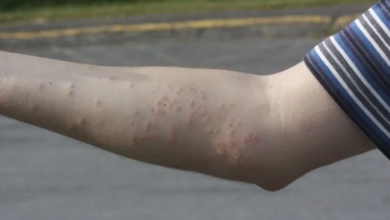 Can You Feel a Bed Bug Bite When It Happens?