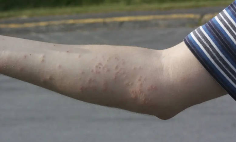 Can You Feel a Bed Bug Bite When It Happens?